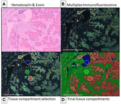 Multiplex Immunofluorescence and the Digital Image Analysis Workflow for Evaluation of the Tumor Immune Environment in Translational Research